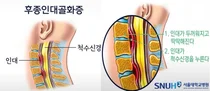 서울대병원, 목 아프면 무조건 디스크? 후종인대골화증 가능성 있다