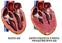 비후성 심근증, 심장 예후 평가 새 관점 제시
