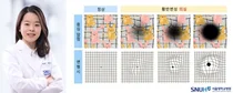 서울대병원, 실명까지 유발하는 황반변성 자가진단 방법은?