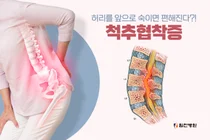'척추협착증' 구부린 자세가 점점 편해진다면 의심해봐야