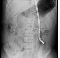 괴사성 췌장염, 내시경적 괴사제거술 치료 