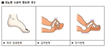 한림대동탄성심병원, 당뇨발 환자 어떤 경우는 수술 심각하게 고려해야