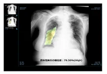 제이엘케이, 인공지능 (AI) 폐질환 솔루션 일본 PMDA 인허가 획득