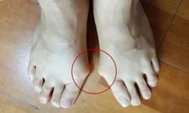 고대구로, 하이힐 고집하다 발 변형 유발