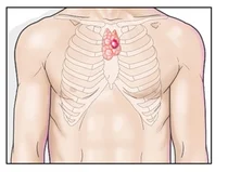 고대구로, 면역세포 만드는 '흉선' 퇴화하지 않으면 '흉선암'의 원인
