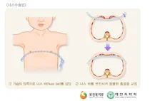 부천성모병원, 우리 아이 '오목가슴' 수술해야할까?