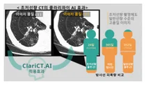 클라리파이, AI 기술로 초저선량 CT 가능성 입증