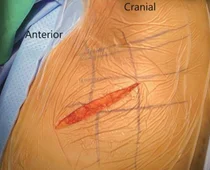 겨드랑이 접근법 통한 최신 치료기술 개발 성공
