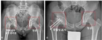 세계최초, 내분비질환 대퇴골두 골단 분리증 발병률 규명