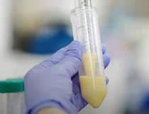 킴 카다시안도 반한 K-의료…지방줄기세포, 의료관광 '키플레이어' 될까?