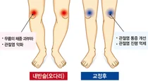강동경희대병원, 관절염으로 변형된 오다리, 교정술 필요한 이유는?