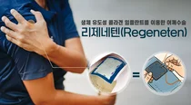 날개병원, 어깨수술 리제네텐, 동종이식물패치로 재파열률줄여 회복빨라