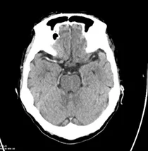 ㈜휴런, AI활용 시 뇌졸중 치료 시작 소요 시간 약 41% 감소
