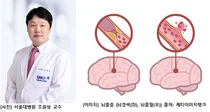 치매 유발, 5대 사망원인 뇌졸중의 진실