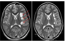 뇌전증 수술은 필수의료이다...로봇 뇌전증 수술비 여전히 비급여