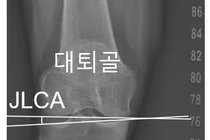 서울대병원, 무릎 퇴행성 관절염 가속 진행 예측 지표 확인