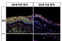 코로 두개저종양 수술 시 ‘후각 저하’, 나이 따라 다르다
