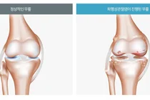 노화로 인한 퇴행성 관절염, 운동은 좋지만 등산은 조심해야
