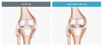 노화로 인한 퇴행성 관절염, 운동은 좋지만 등산은 조심해야
