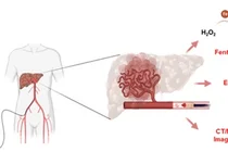  영상 진단과 국소 치료 동시 수행하는 ‘간암 색전용 주사형 하이드로겔’ 개발