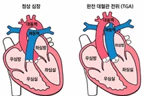 서울대병원-전남대병원, 완전 대혈관 전위 수술 후 장기 안정성 확인