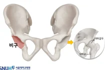 서울대병원, MAKO 로봇 활용 인공고관절 재치환술 국내 최초 시행
