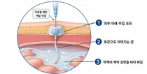 항암제 직접 들어가는 ‘길’ 열었더니...복막전이 4기 위암 돌파구 됐다