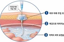 항암제 직접 들어가는 ‘길’ 열었더니...복막전이 4기 위암 돌파구 됐다