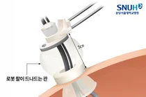 몸속 좁아 어려운 ‘소아 단일공 로봇수술’, 국내 최초 다기관 연구로 안전성 확인