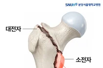 고관절 골절, 불안정한 경우에도 골절 부위 정확히 맞추면 수술 결과 좋아
