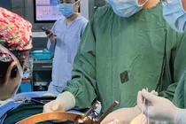 꿈의 레이저 뇌전증 수술 한·중 협력으로 최초 성공