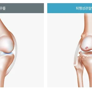 노화로 인한 퇴행성 관절염, 운동은 좋지만 등산은 조심해야

