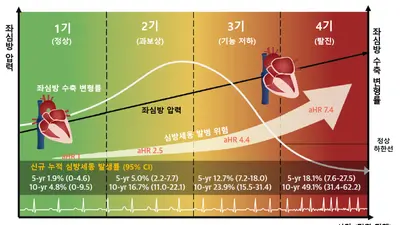 서울대병원, 비후성 심근증 심방세동 위험 가려내는 ‘좌심방 4단계 병기 체계’ 개발