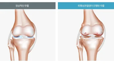 노화로 인한 퇴행성 관절염, 운동은 좋지만 등산은 조심해야
