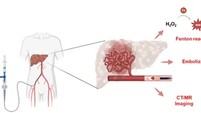  영상 진단과 국소 치료 동시 수행하는 ‘간암 색전용 주사형 하이드로겔’ 개발