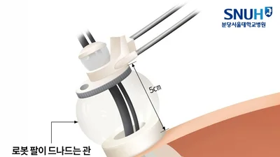 몸속 좁아 어려운 ‘소아 단일공 로봇수술’, 국내 최초 다기관 연구로 안전성 확인