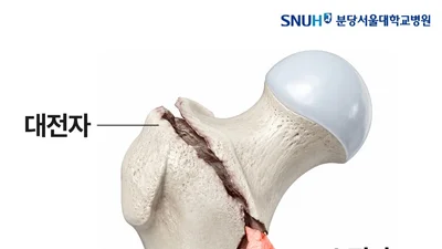 고관절 골절, 불안정한 경우에도 골절 부위 정확히 맞추면 수술 결과 좋아