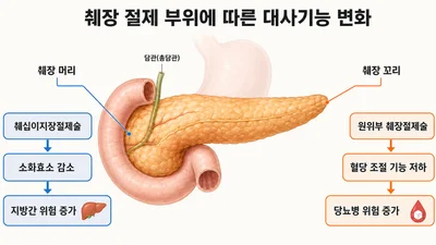 췌장 수술, 생존 넘어 ‘대사질환’ 예방으로 패러다임 전환