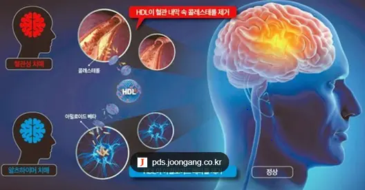▲종근당의 콜린알포세레이트 임상(852명) 장기 추적에서는 인지개선 효과가 확인됐다.