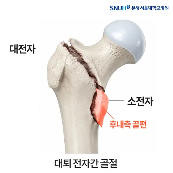 [사진] 불안정성 대퇴 전자간 골절. 대전자와 소전자의 사이가 부러질 때 후내측 골편도 같이 떨어지면 예후가 더 좋지 않다고 해, 불안정한 대퇴 골절 중 하나로 평가한다.