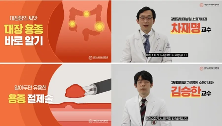 대장암 예방을 위한 용종 바로 알기