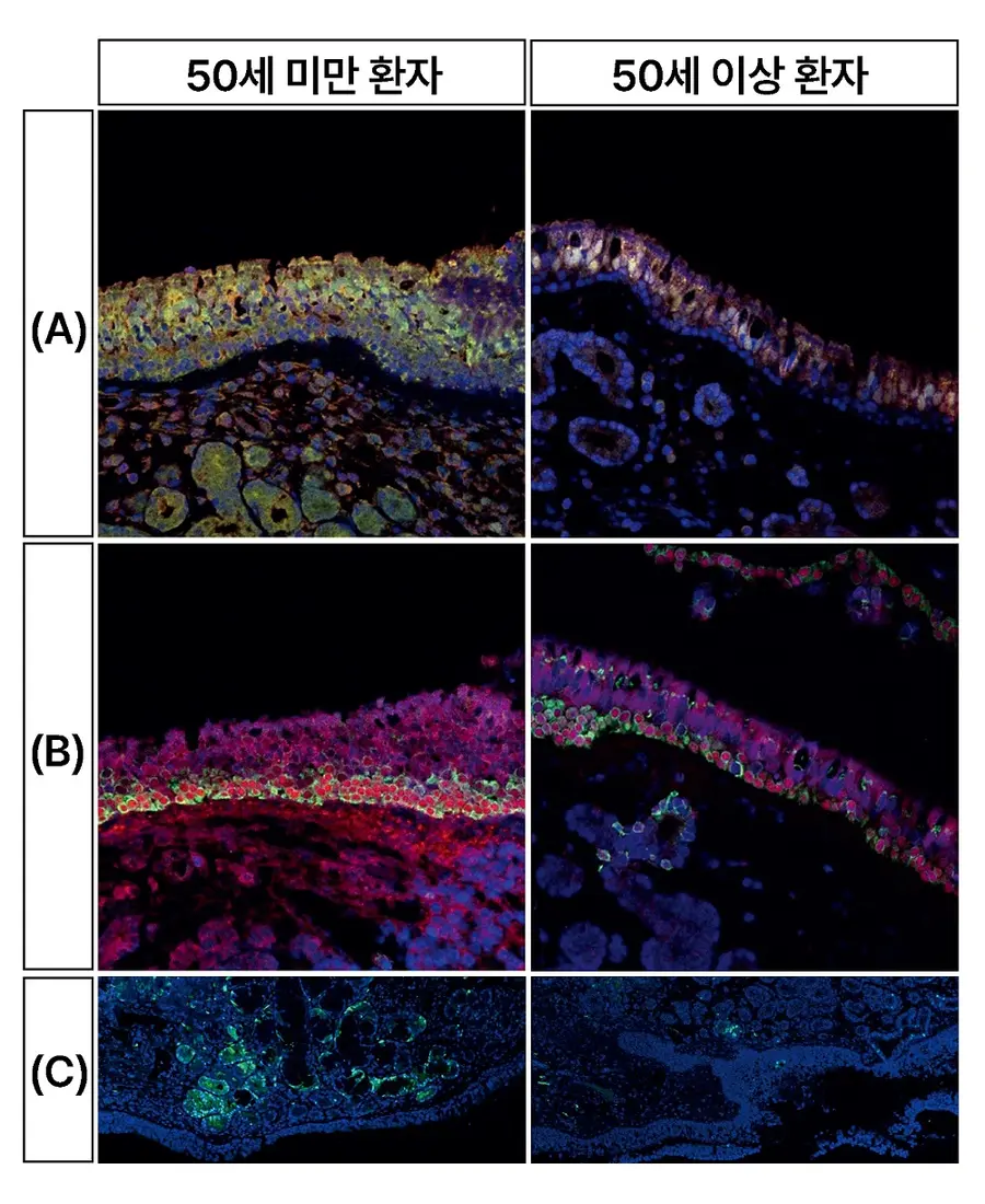 [그림] 50세 미만 환자(좌)와 50세 이상 환자(우)의 세포 형광 염색 결과