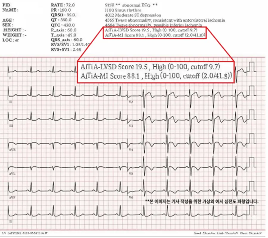 ▲에티아(AiTiA) 분석 결과 화면 예시. 환자에서 급성 심근경색 및 심부전 고위험이 포착된 모습.