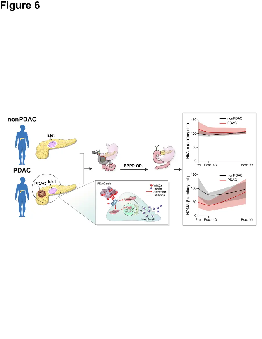 (그림) 췌장암 연관 고혈당과 관련 병태생리 기전 모식도.