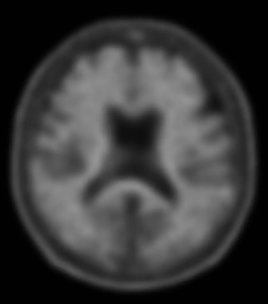 사진 : 환자 PET 영상 화면