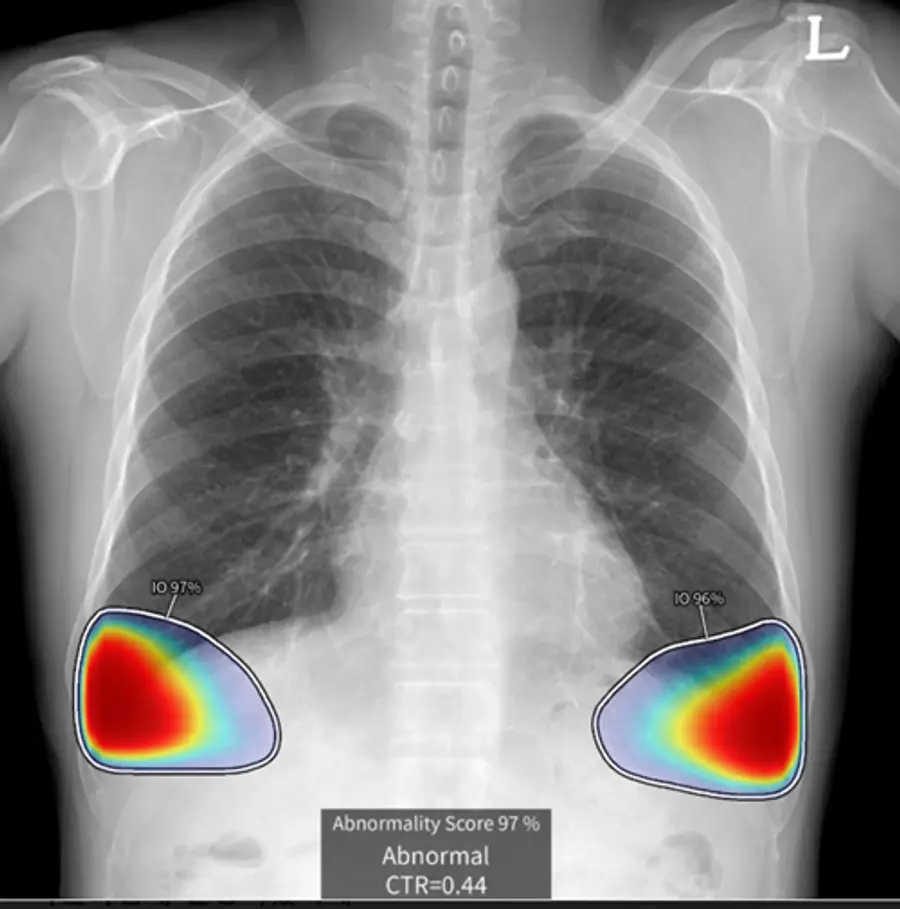 VUNO Med-Chest X-ray 진단 보조 이미지