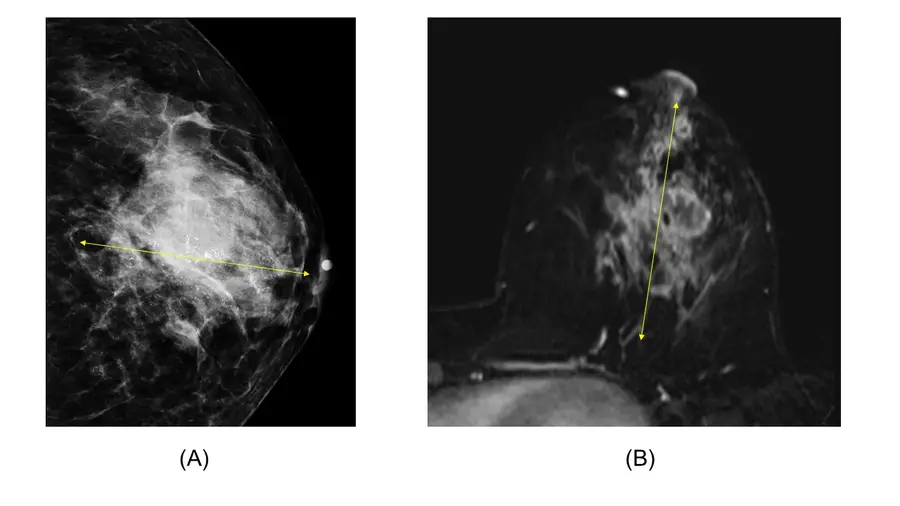 (사진1) 선행항암화학요법 이전에 시행한 유방촬영술(A) 유방 MRI(B)