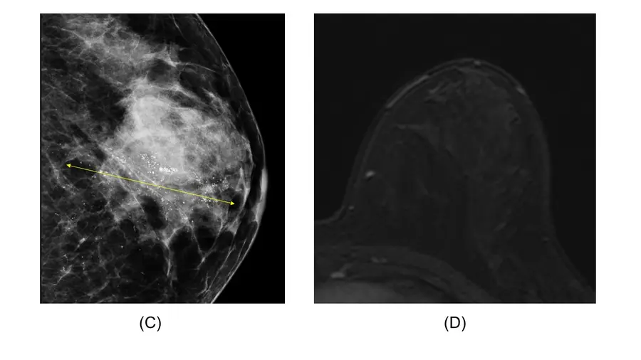 (사진2) 선행항암화학요법 이후에 시행한 &nbsp;유방촬영술(C), 유방 MRI(D)