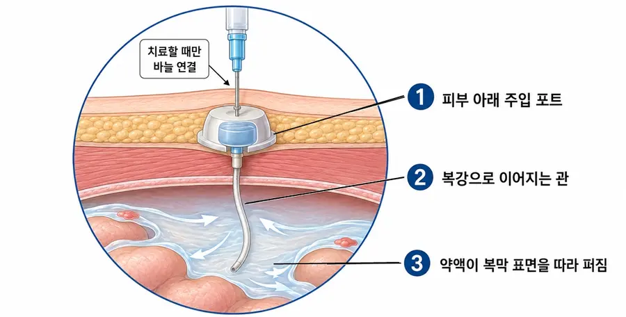 [그림] 복강 내 파클리탁셀 주입 치료 개념도