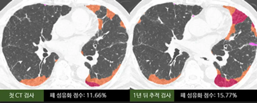 [사진] 사진은 AI 기반 CT 정량 분석 기술로 섬유화가 진행된 폐 영역을 인식해 75세 남성 특발성 폐섬유증 환자의 1년간 폐 섬유화 진행 정도를 비교한 모습. 첫 검사 당시 폐 섬유화 점수는 11.66%이었으나 1년 뒤 추적 검사에서 15.77%로 증가했다. 망상 음영(주황색)은 9.34%에서 11.39%로, 벌집 모양 음영(분홍색)은 2.32%에서 4.38%로 늘었다.